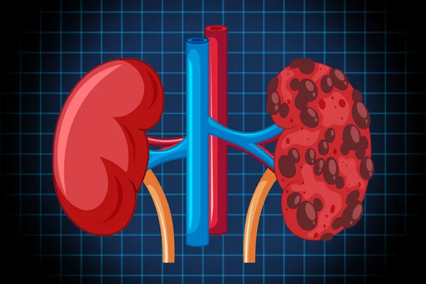 Chronic Kidney Disease CKD