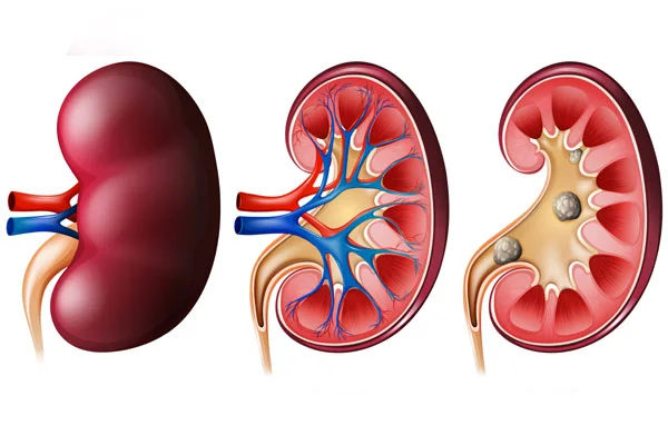 Renal Stone Disease