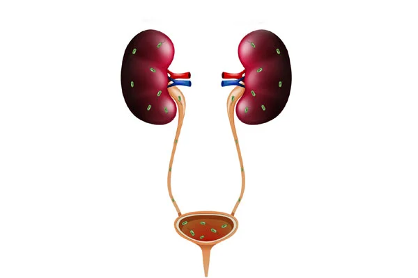 Complicated Urinary Tract Infections UTI